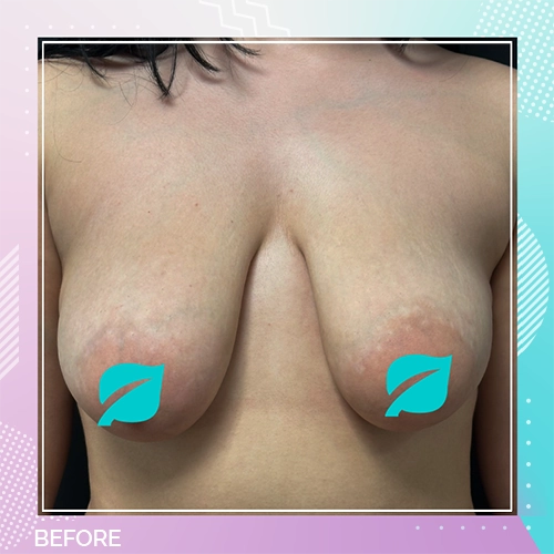 breast uplift patient 5 before
