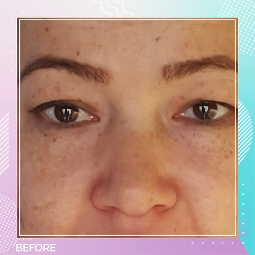eyelid patient 6 before