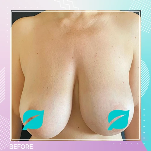 Breast Reduction Patient 1 Before
