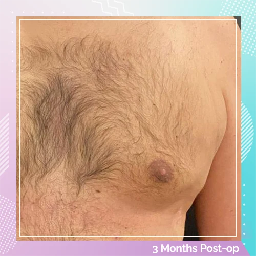 Gynecomastia patient1 after