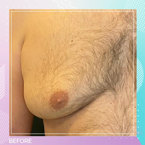 Gynecomastia patient1 before