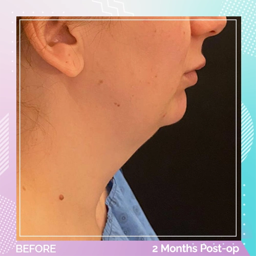 Liposuction patient 1 before