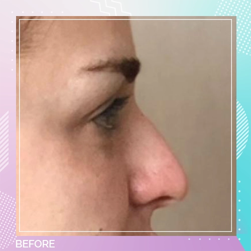 Nose patients 1 Before
