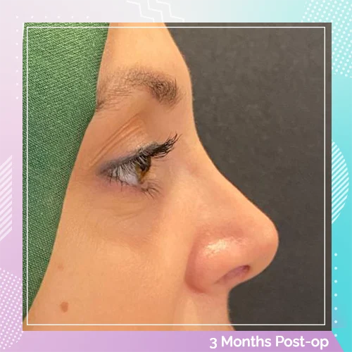 Nose patients 2 After