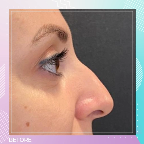 Nose patients 2 Before