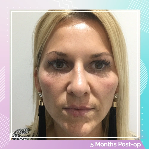 HS Lower Eyelid Mid Facelift Patient After