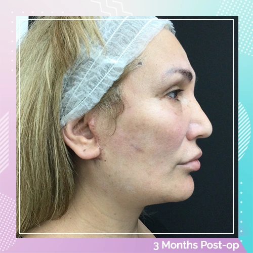 HS Upper Eyelid Full Facelift Patient 3 After