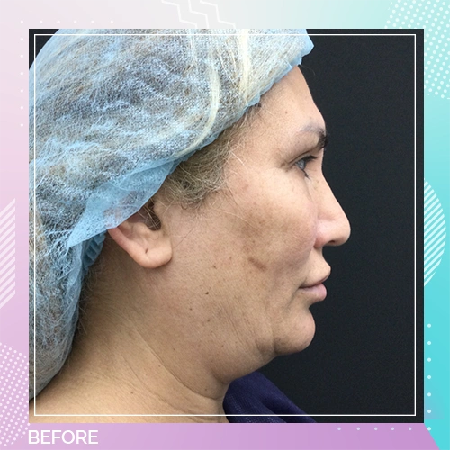 HS Upper Eyelid Full Facelift Patient 3 Before