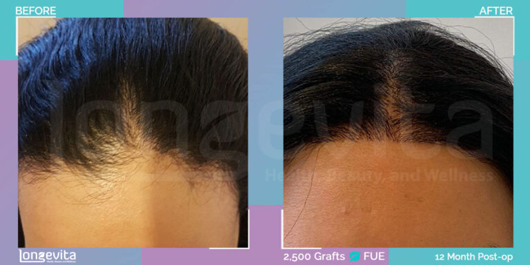 22 year old female hair transplant turkey