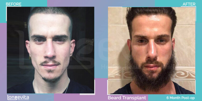 3000 graft beard hair transplant turkey