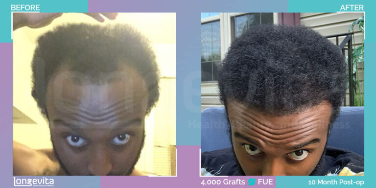afro male hair transplant turkey