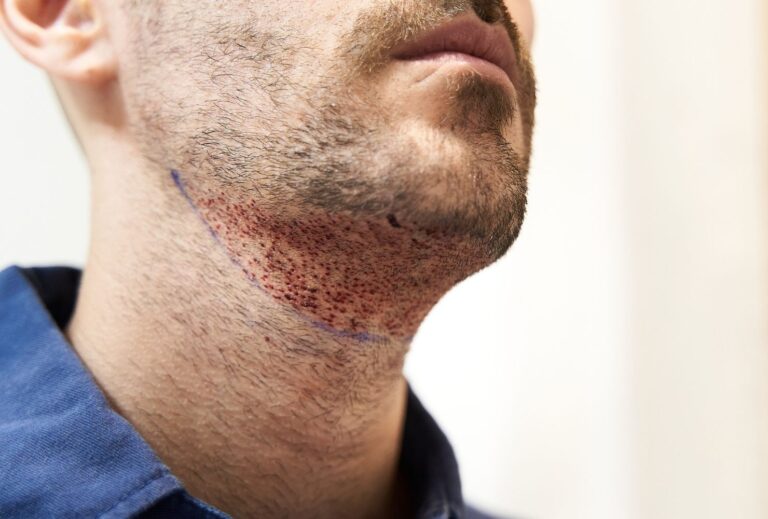 beard hair transplant turkey