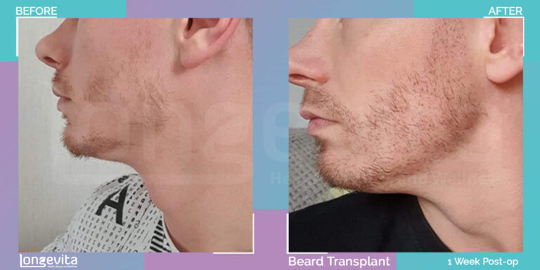 facial hair transplant 1 week before after results
