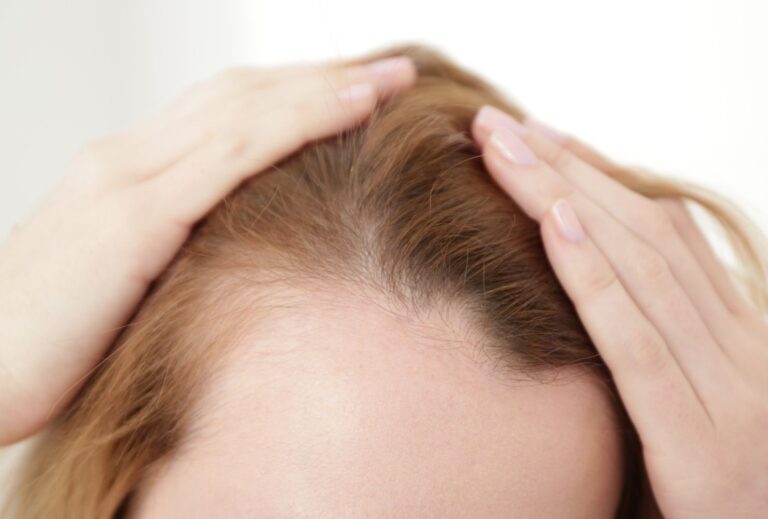 female hair transplant turkey