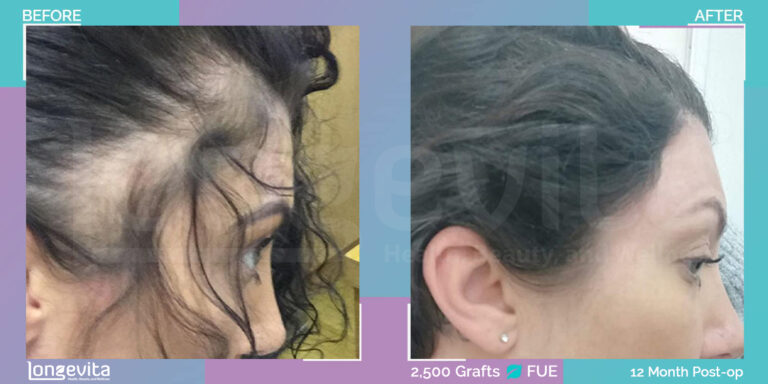 female hair transplant turkey before after age 34