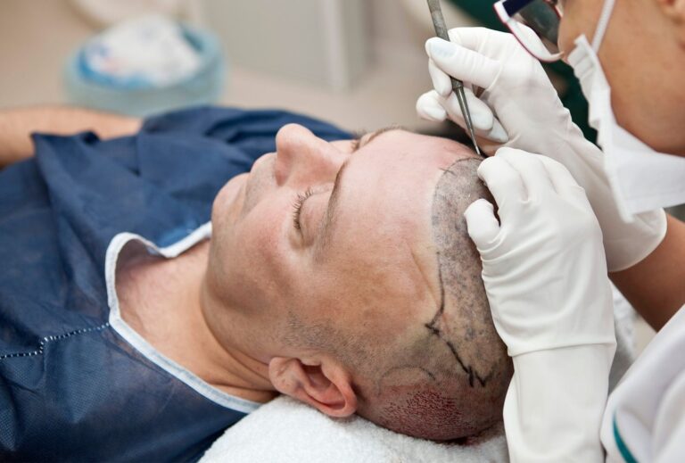 fue hair transplant turkey