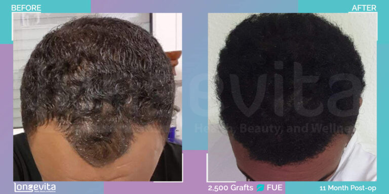 hair transplant turkey afro hair before after results 10 months