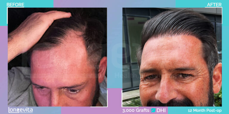 hair transplant turkey before after dhi 12 months recovery stage