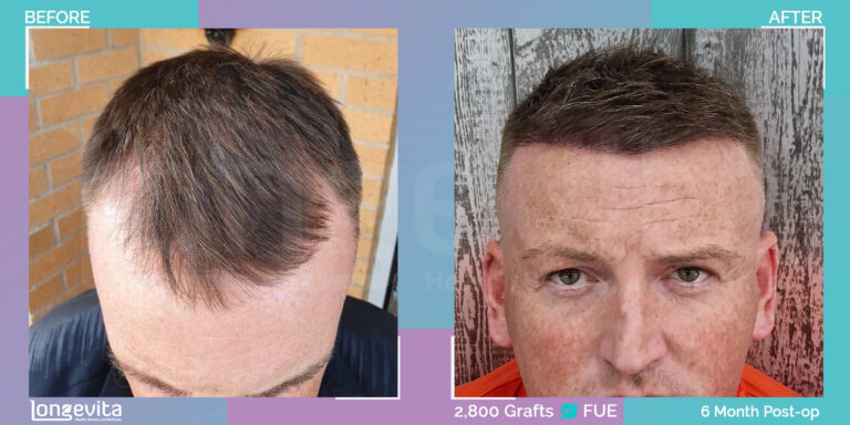 hair transplant turkey fue before after 6 month