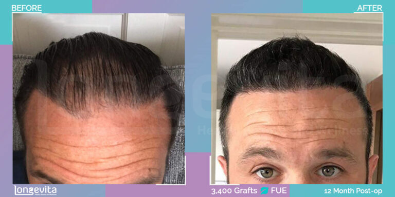 male hair transplant turkey 3400 grafts fue