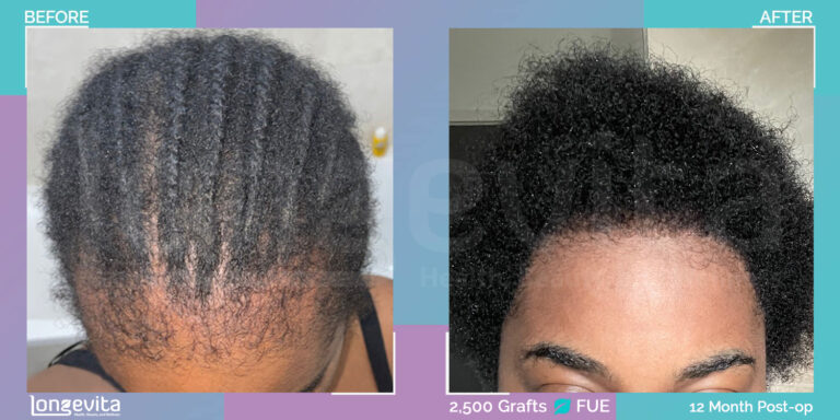 womens hair transplant turkey 13 month recovery