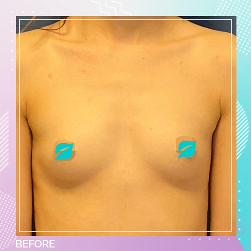 Breast Enlargement Patient 17 before – Dr Tamer