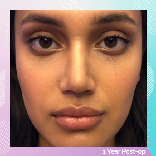 Nose Job Patient 18 after Dr Tamer