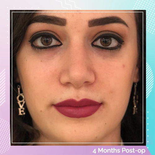 Nose Job Patient 20 after Dr Tamer