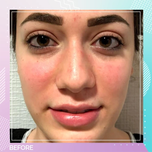 Nose Job Patient 20 before – Dr Tamer