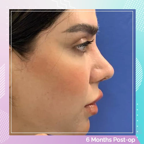 Nose Job Patient 21 after Dr Tamer