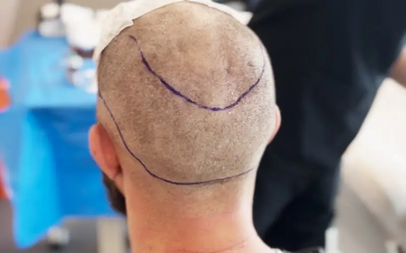 A FUE patient shows his donor area after shaving, preparing for the hair transplant procedure.