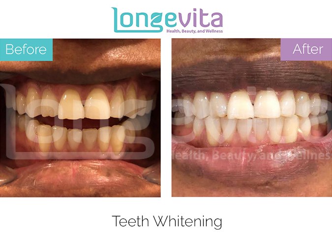 Teeth whitening before after 3.jpg
