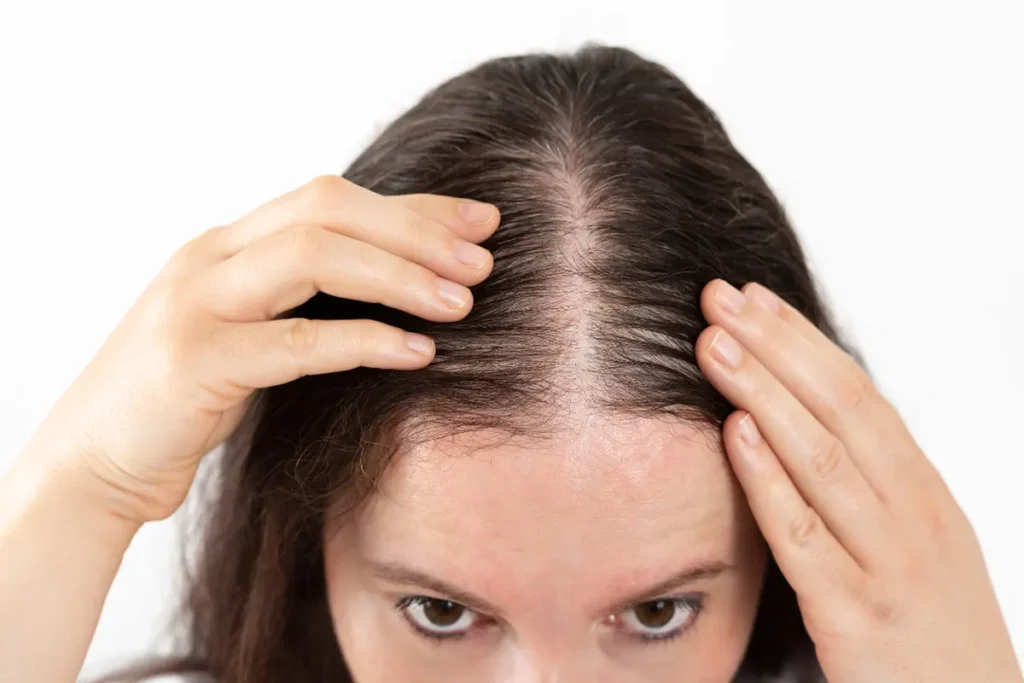 top view of a woman’s scalp showing Christmas tree pattern hair thinning