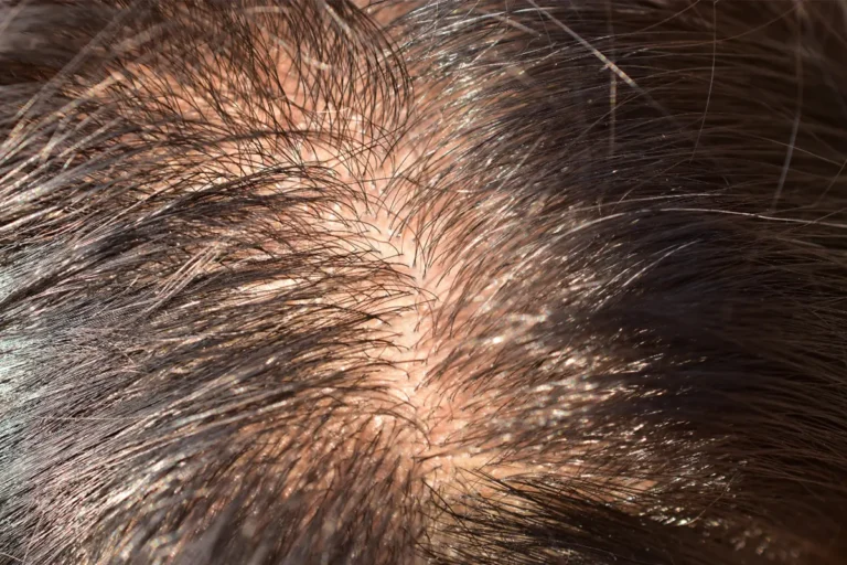 close-up of scalp showing thinning hair and visible skin