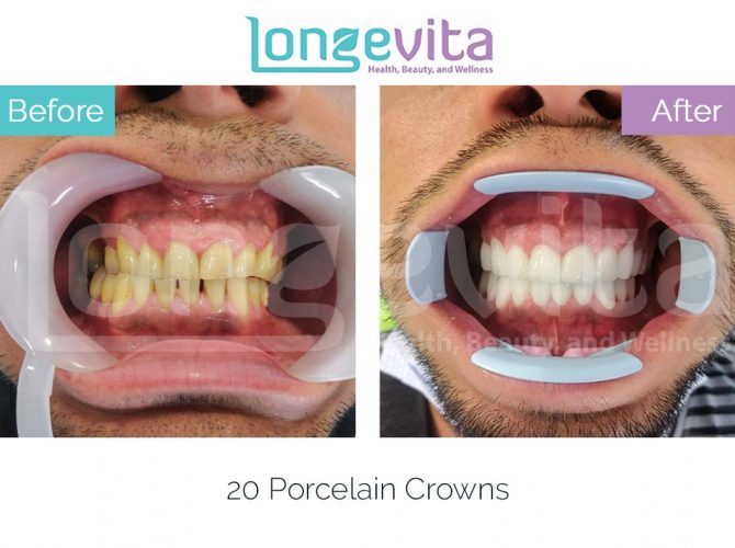 dental crowns turkey before and after 14 670x500 1.jpg