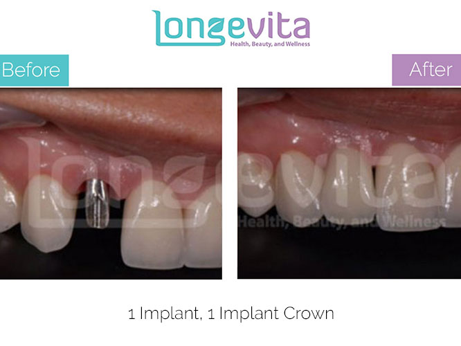 dental implant before and after 4.jpg