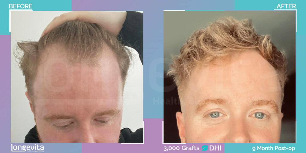 before and after images of dhi hair transplant 9 month recovery stage