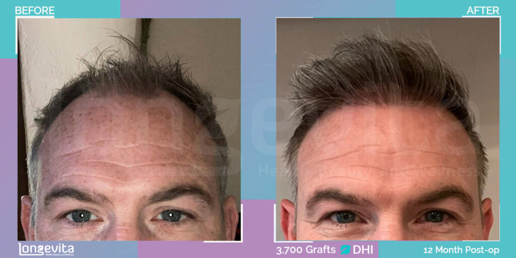 DHI patient, 3700 graft hair transplant, 12 months recovery stage