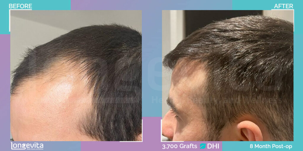 3700 Grafts DHI Hair Transplant Before and After Results After 8 Months