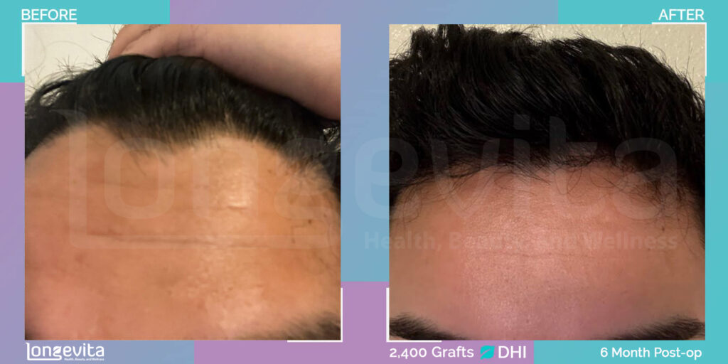 DHI Hair Transplant Before and After Results After 6 Months 2400 Grafts