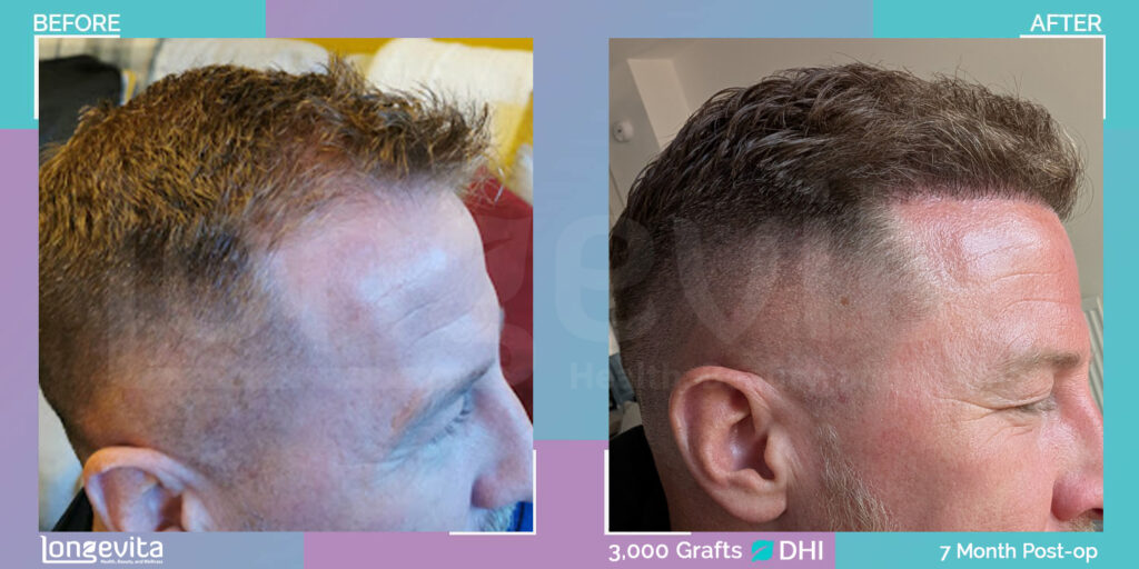 36 year old male, direct hair implantation before and after results