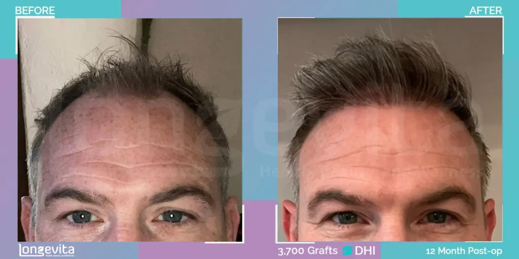 dhi hair transplant before after 3700 grafts.jpg