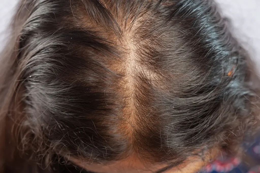 top view of a woman's scalp showing visible hair thinning along the parting line