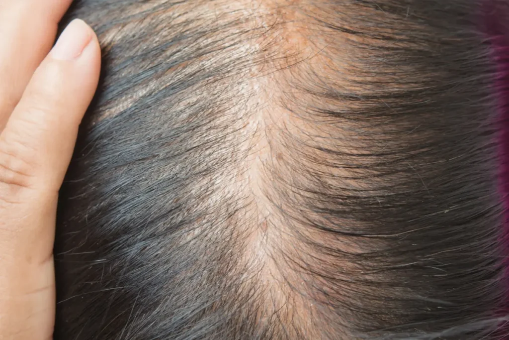 close-up of a woman’s scalp showing male-pattern hair loss with frontal thinning