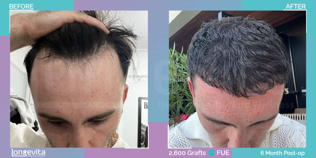 FUE patient before and after - Dr Hassan