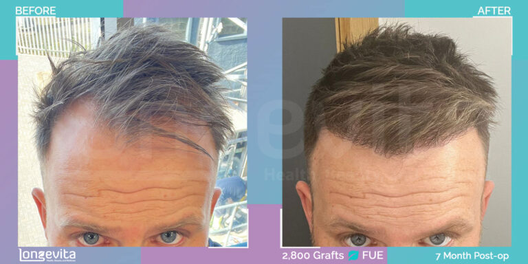 FUE Hair Transplant Results After 7 Months 3,000 Grafts Transformation