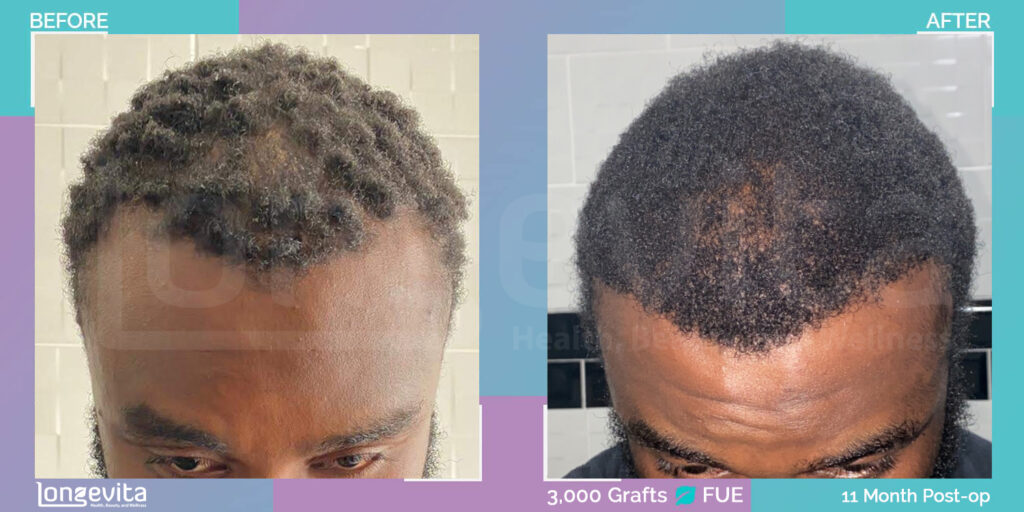 afro male hair transplant before and after images