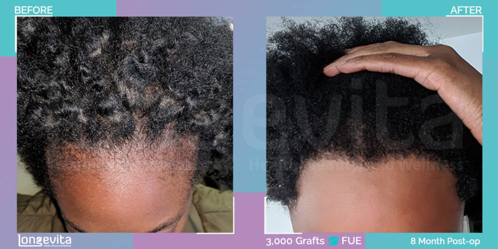 afro womens hair transplant before and after images