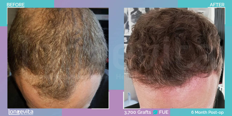 3,700 Grafts FUE Hair Transplant Transformation 6 Month Progress