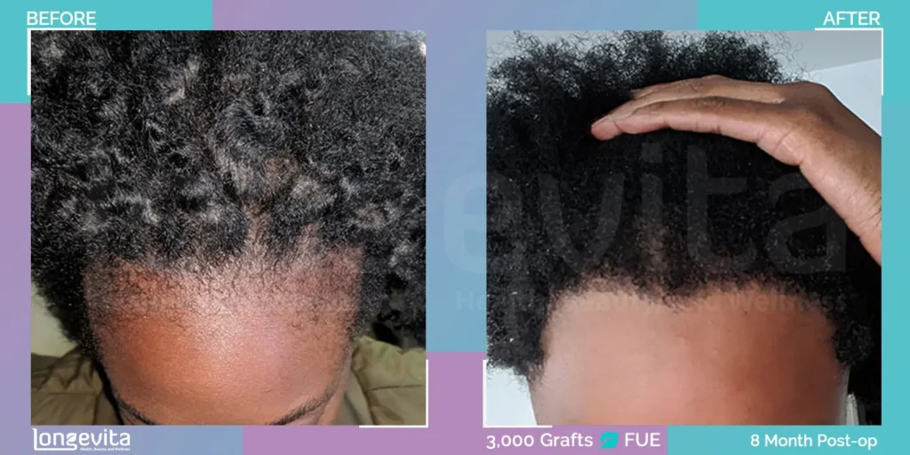 fue hair transplant before after 3000 grafts afro hairline lowering 8 months.jpg